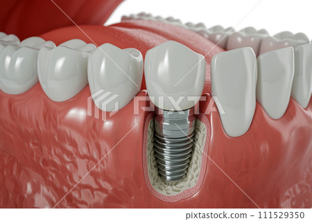 AI-generated content. Close up of dental teeth implant. AI-generated content. Close up of dental teeth implant. 111529350