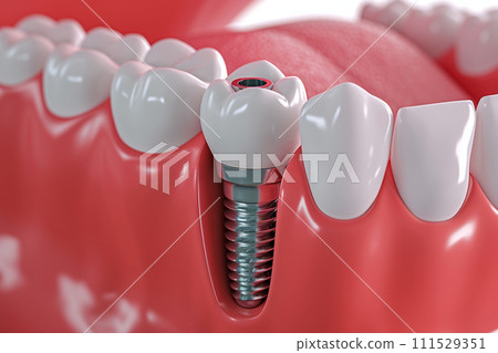 AI-generated content. Close up of dental teeth implant. 111529351