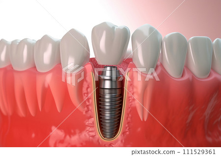 AI-generated content. Close up of dental teeth implant. 111529361