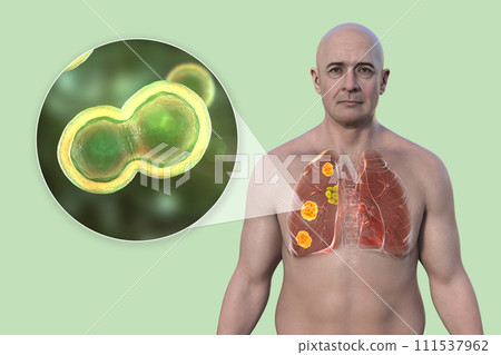 Pulmonary blastomycosis, 3D illustration. 111537962