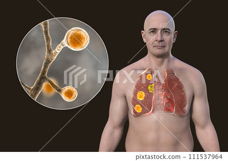 Pulmonary blastomycosis, 3D illustration. Pulmonary blastomycosis, 3D illustration. 111537964