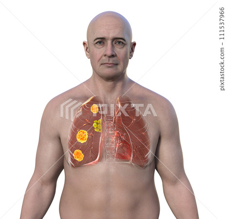 Pulmonary blastomycosis, 3D illustration. Pulmonary blastomycosis, 3D illustration. 111537966