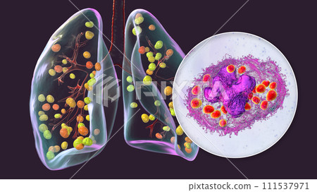Lung histoplasmosis, 3D illustration 111537971