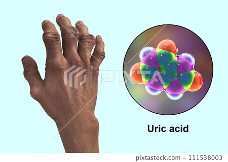 Gout-afflicted hands with deformities, 3D illustration Gout-afflicted hands with deformities, 3D illustration 111538003