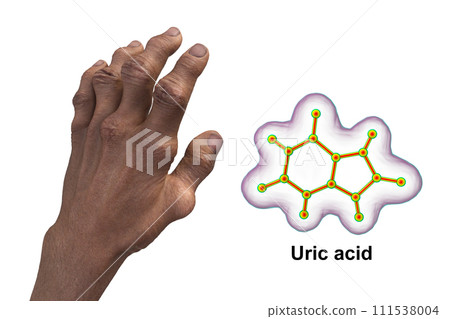 Gout-afflicted hands with deformities, 3D illustration 111538004