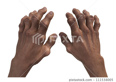 Gout-afflicted hands with deformities, 3D illustration 111538005