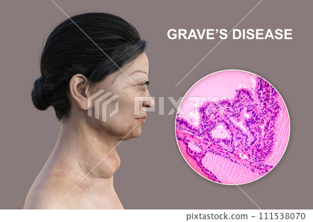 Toxic goiter, 3D illustration and micrograph 111538070