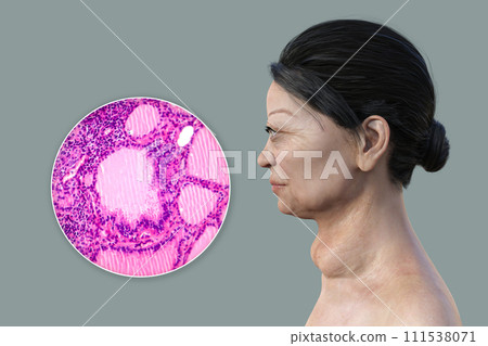 Toxic goiter, 3D illustration and micrograph Toxic goiter, 3D illustration and micrograph 111538071