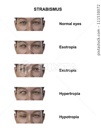 A woman with various strabismus types, 3D illustration A woman with various strabismus types, 3D illustration 111538072