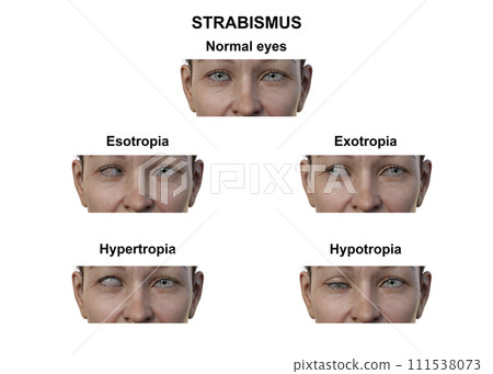 A woman with various strabismus types, 3D illustration 111538073
