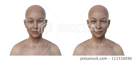 A woman with ptosis, 3D illustration 111538096