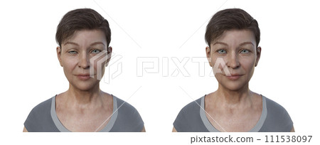 A woman with ptosis, 3D illustration A woman with ptosis, 3D illustration 111538097
