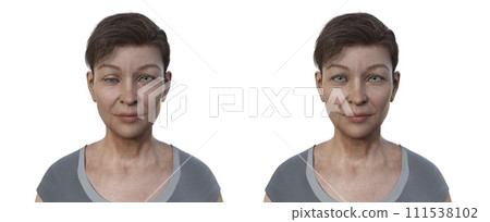 A woman with hypotropia, 3D illustration A woman with hypotropia, 3D illustration 111538102