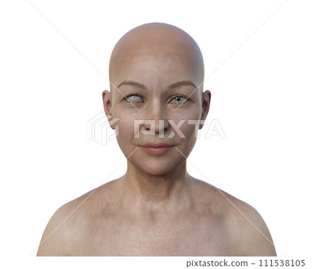 A woman with hypertropia, 3D illustration 111538105