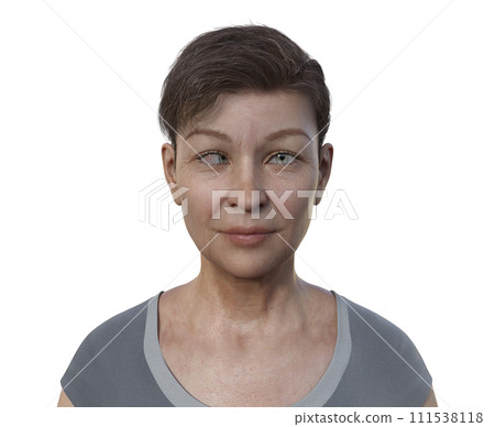 A woman with esotropia, 3D illustration 111538118