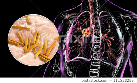 Primary lung tuberculosis with the Ranke complex, 3D illustration Primary lung tuberculosis with the Ranke complex, 3D illustration 111538292
