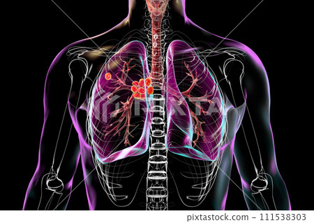 Primary lung tuberculosis, 3D illustration 111538303