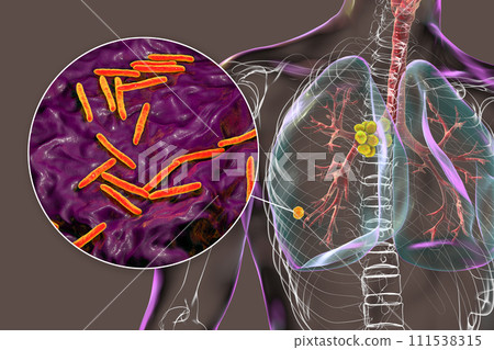 Primary lung tuberculosis, 3D illustration 111538315