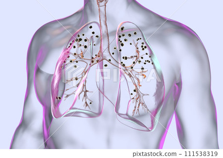 Human lungs with silicosis, 3D illustration Human lungs with silicosis, 3D illustration 111538319