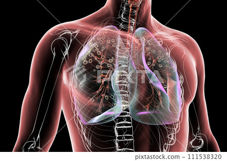 Human lungs with silicosis, 3D illustration Human lungs with silicosis, 3D illustration 111538320