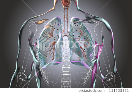 Human lungs with silicosis, 3D illustration 111538321