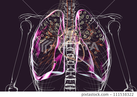 Human lungs with silicosis, 3D illustration Human lungs with silicosis, 3D illustration 111538322