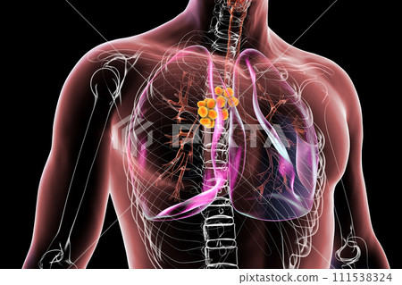 Mediastinal lymphadenitis, 3D illustration 111538324