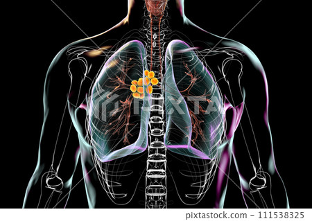 Mediastinal lymphadenitis, 3D illustration 111538325