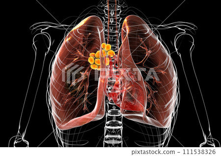 Mediastinal lymphadenitis, 3D illustration 111538326