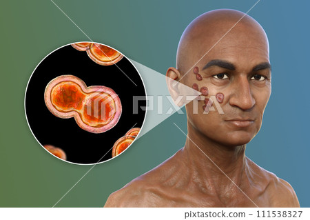 A man with cutaneous blastomycosis, 3D illustration 111538327