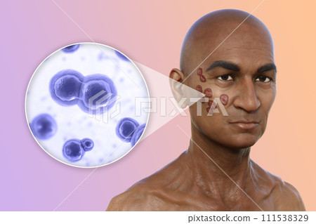 A man with cutaneous blastomycosis, 3D illustration 111538329