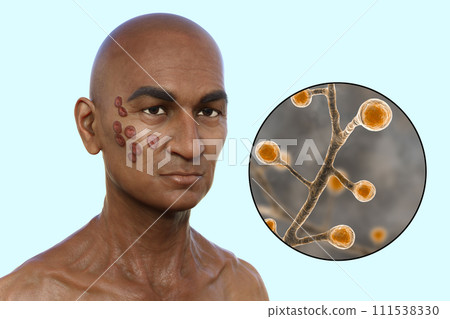 A man with cutaneous blastomycosis, 3D illustration 111538330