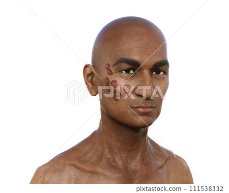 A man with cutaneous blastomycosis, 3D illustration 111538332