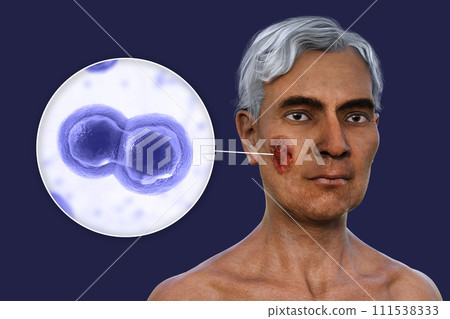 A man with cutaneous blastomycosis, 3D illustration A man with cutaneous blastomycosis, 3D illustration 111538333