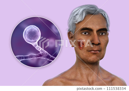 A man with cutaneous blastomycosis, 3D illustration A man with cutaneous blastomycosis, 3D illustration 111538334