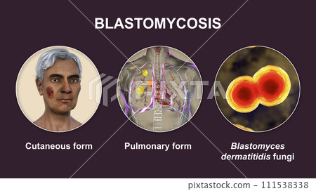 Clinical forms of blastomycosis, 3D illustration 111538338