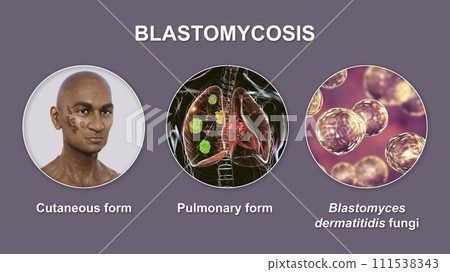 Clinical forms of blastomycosis, 3D illustration 111538343