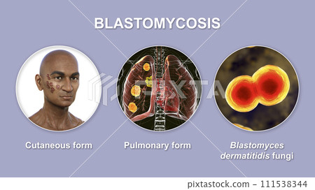 Clinical forms of blastomycosis, 3D illustration 111538344