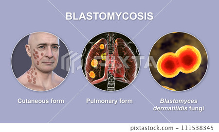 Clinical forms of blastomycosis, 3D illustration 111538345