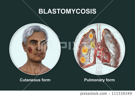 Clinical forms of blastomycosis, 3D illustration Clinical forms of blastomycosis, 3D illustration 111538349