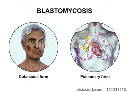 Clinical forms of blastomycosis, 3D illustration 111538350