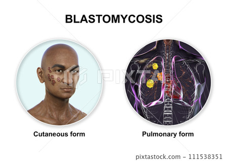 Clinical forms of blastomycosis, 3D illustration Clinical forms of blastomycosis, 3D illustration 111538351