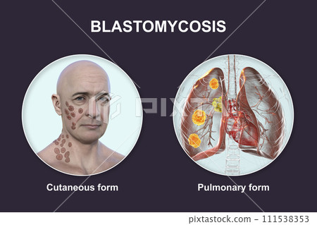 Clinical forms of blastomycosis, 3D illustration 111538353