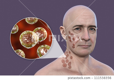 A man with cutaneous blastomycosis, 3D illustration 111538356