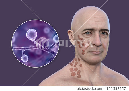 A man with cutaneous blastomycosis, 3D illustration A man with cutaneous blastomycosis, 3D illustration 111538357