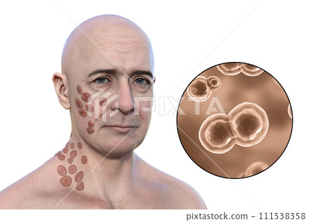 A man with cutaneous blastomycosis, 3D illustration 111538358