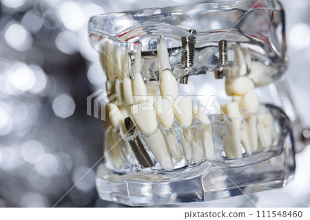 Dental tooth implant titanium prosthetic dentists model. Dental tooth implant titanium prosthetic dentists model. 111548460
