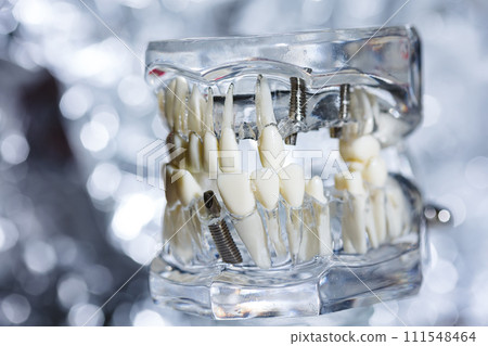 Dental tooth implant titanium prosthetic dentists model. Dental tooth implant titanium prosthetic dentists model. 111548464