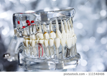 Dental tooth implant titanium prosthetic dentists model. Dental tooth implant titanium prosthetic dentists model. 111548486