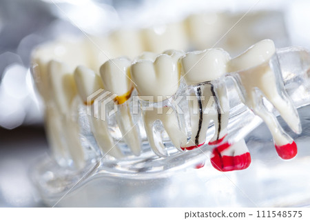 Dental implant, artificial tooth roots into jaw, root canal of dental treatment 111548575